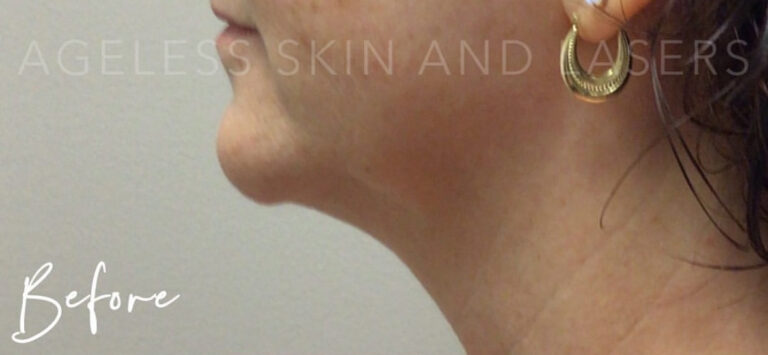 Before Image: RF Microneedling - left-side