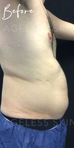 Before Image: CoolSculpting & Emsculpt Neo