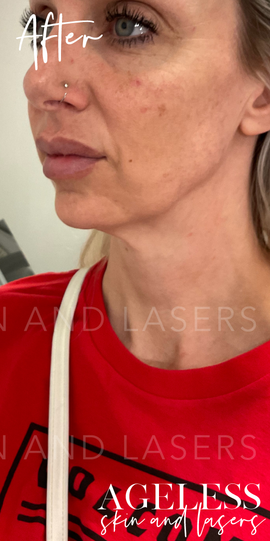 After Image: Lower Face Dermal Filler - left-front-oblique