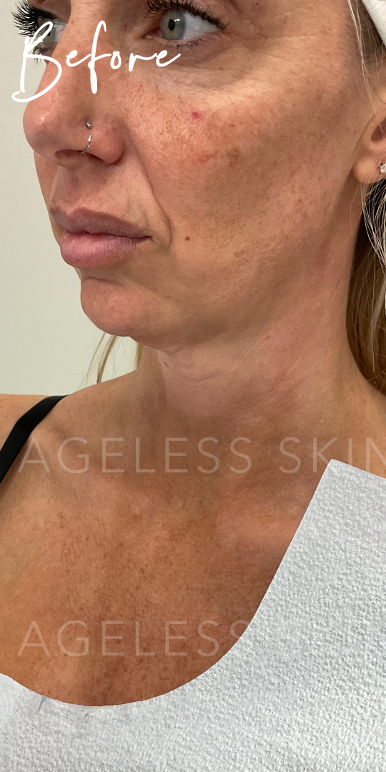 Before Image: Lower Face Dermal Filler - left-front-oblique
