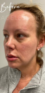 Facial Balancing with Dermal Filler