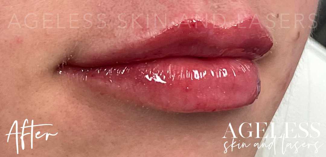 After Image: Lip Filler - right-front-oblique