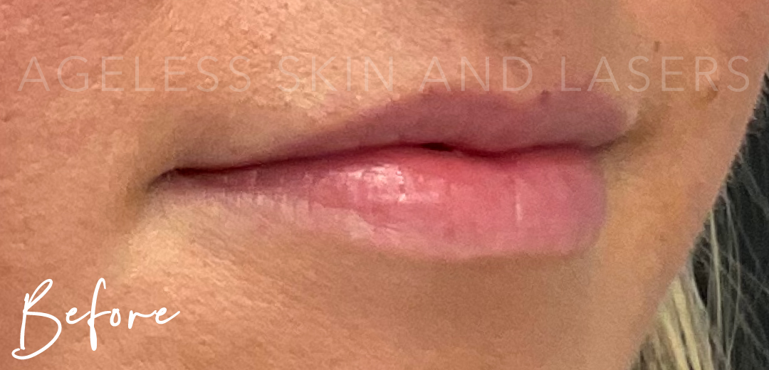 Before Image: Lip Filler - right-front-oblique