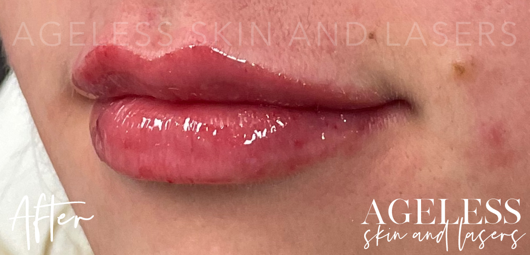 After Image: Lip Filler - left-front-oblique