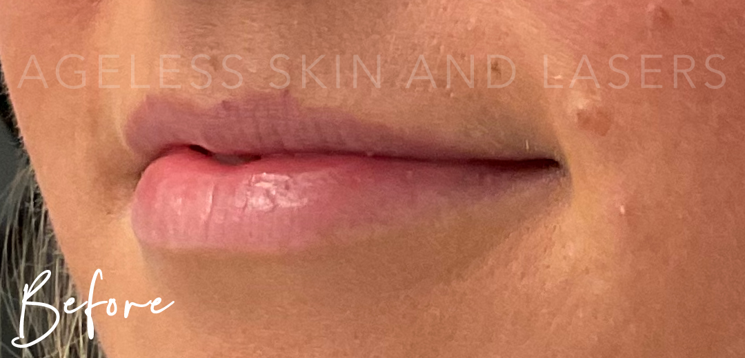 Before Image: Lip Filler - left-front-oblique
