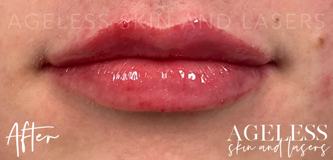After Image: Lip Filler - front