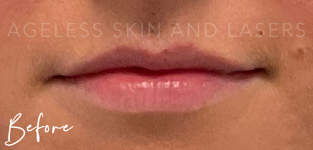 Before Image: Lip Filler - front