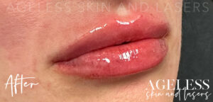 After Image: Lip Filler