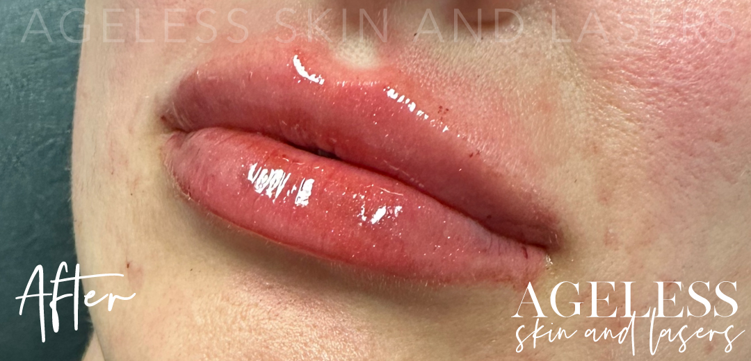 After Image: Lip Filler - left-front-oblique