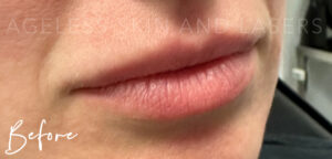 Before Image: Lip Filler