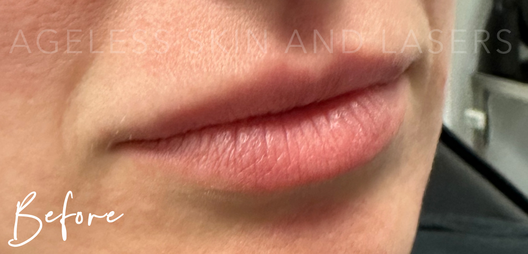 Before Image: Lip Filler - right-front-oblique