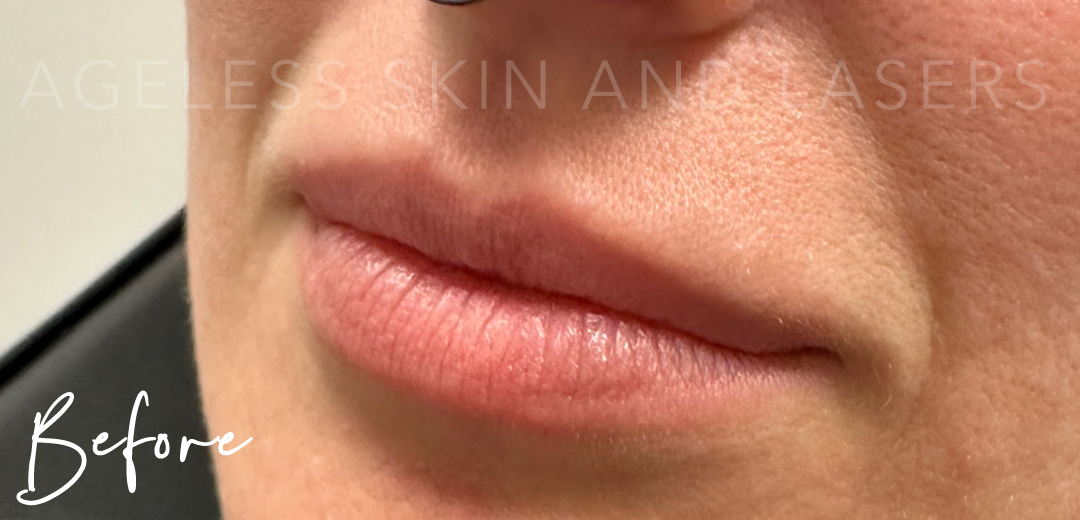 Before Image: Lip Filler - left-front-oblique