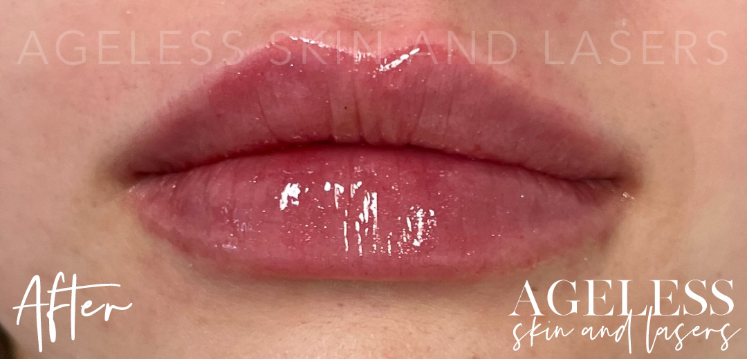 After Image: Lip Filler - front