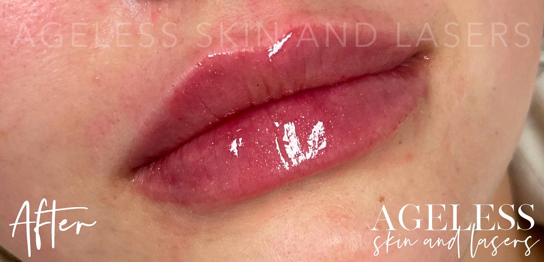 After Image: Lip Filler - right-front-oblique