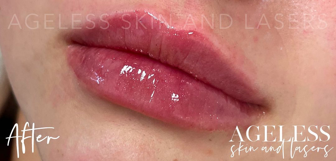 After Image: Lip Filler - left-front-oblique