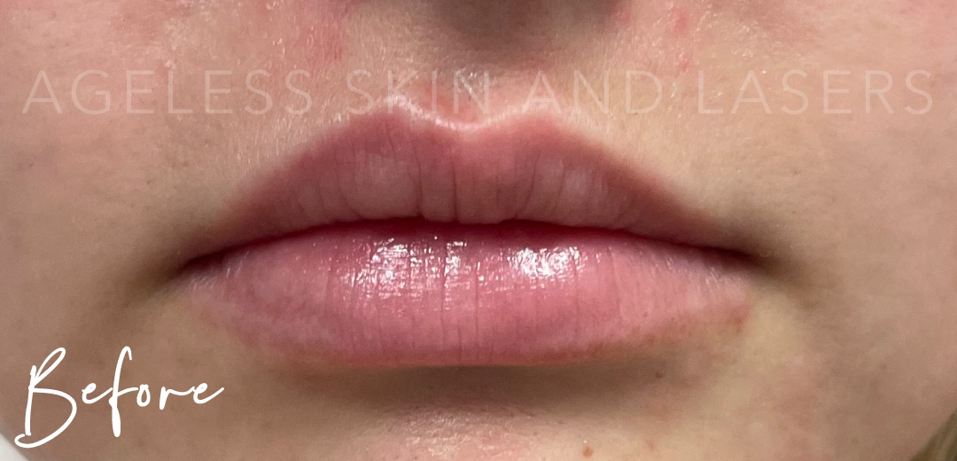 Before Image: Lip Filler - front