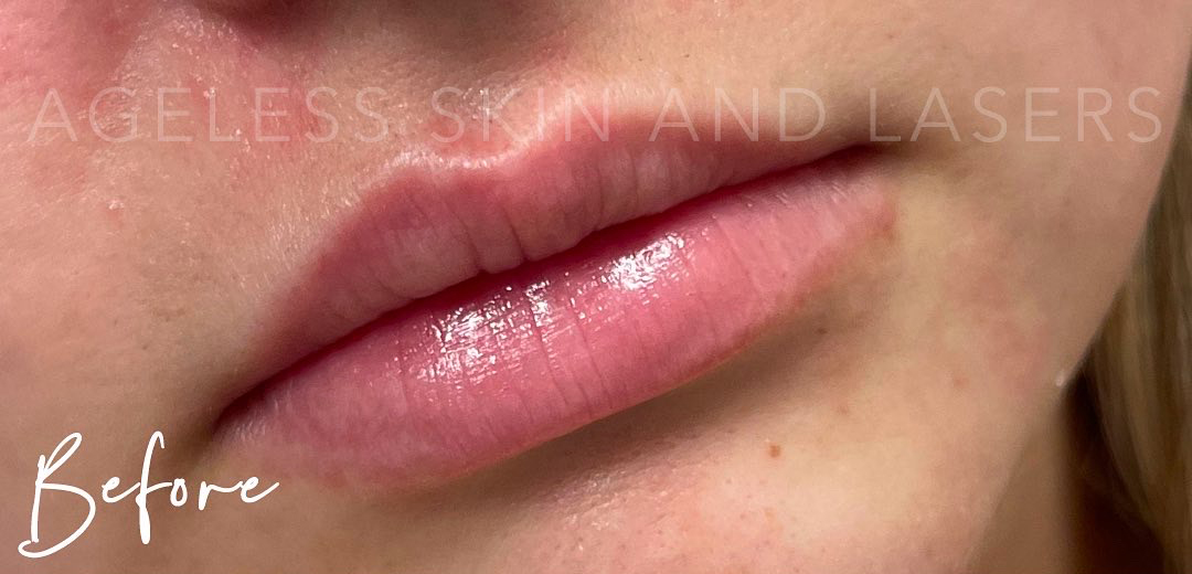Before Image: Lip Filler - right-front-oblique