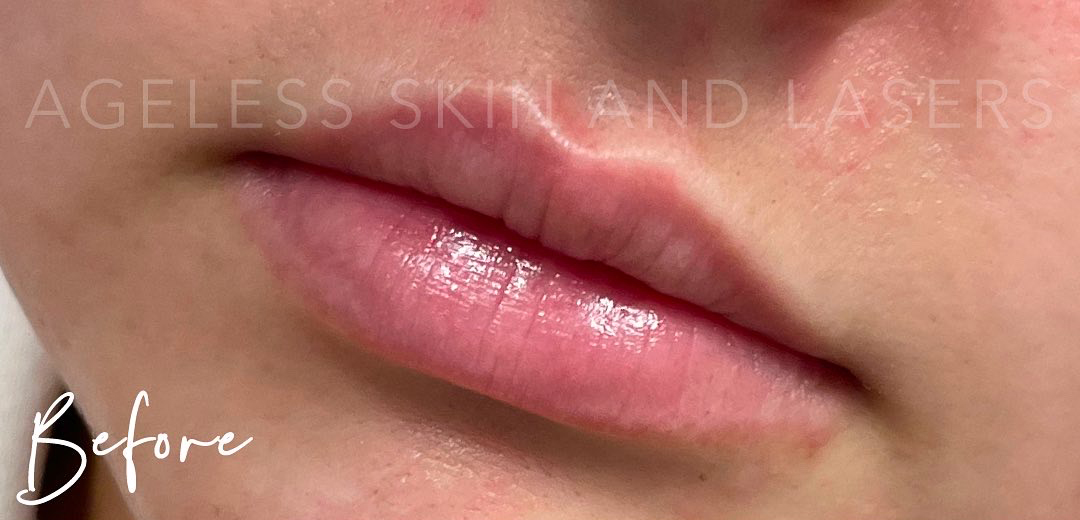 Before Image: Lip Filler - left-front-oblique