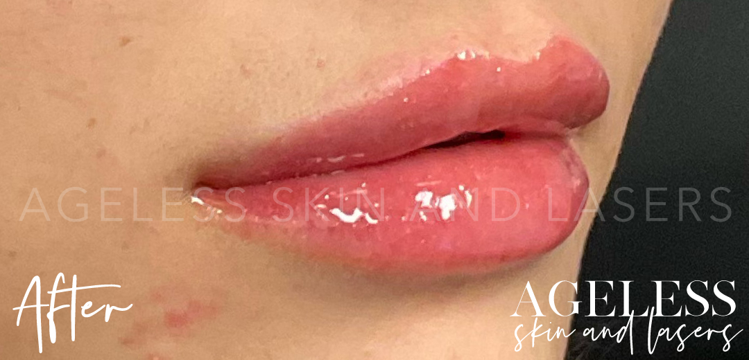 After Image: Lip Filler - right-front-oblique