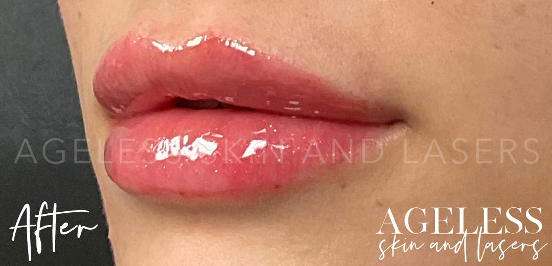 After Image: Lip Filler - left-front-oblique
