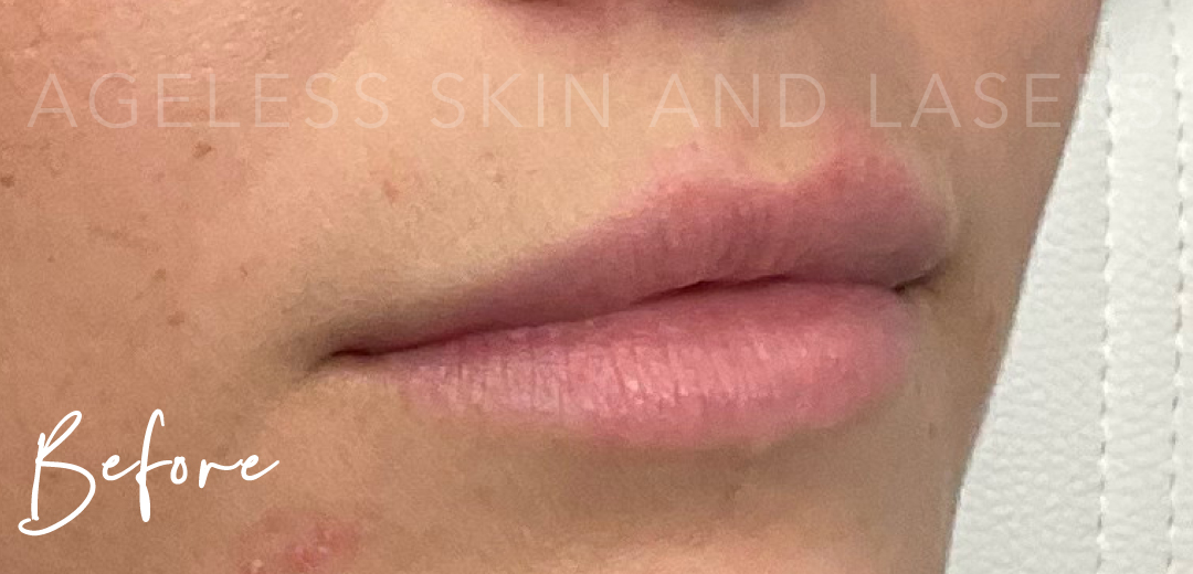 Before Image: Lip Filler - right-front-oblique