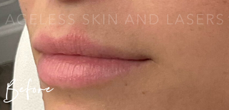 Before Image: Lip Filler - left-front-oblique