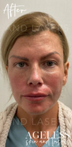 After Image: Sculptra
