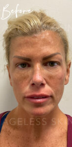 Before Image: Sculptra