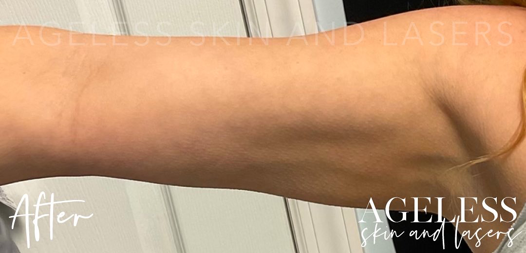 After Image: CoolSculpting - front