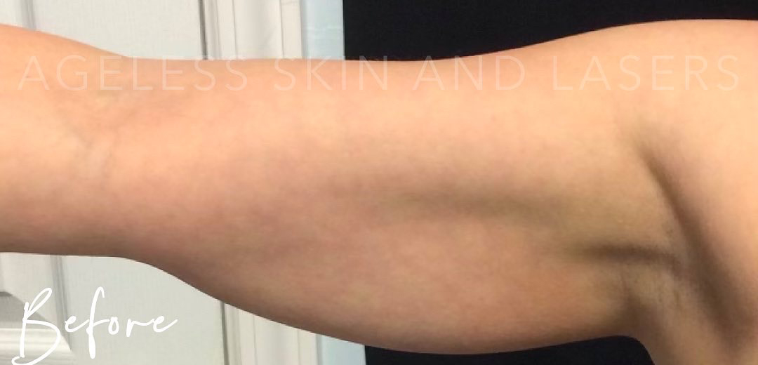Before Image: CoolSculpting - front
