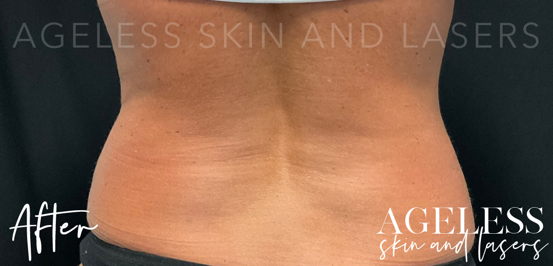 After Image: CoolSculpting - back