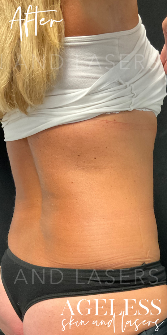 After Image: CoolSculpting - right-back-oblique