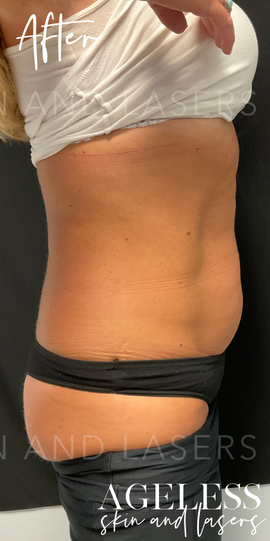 After Image: CoolSculpting - right-side