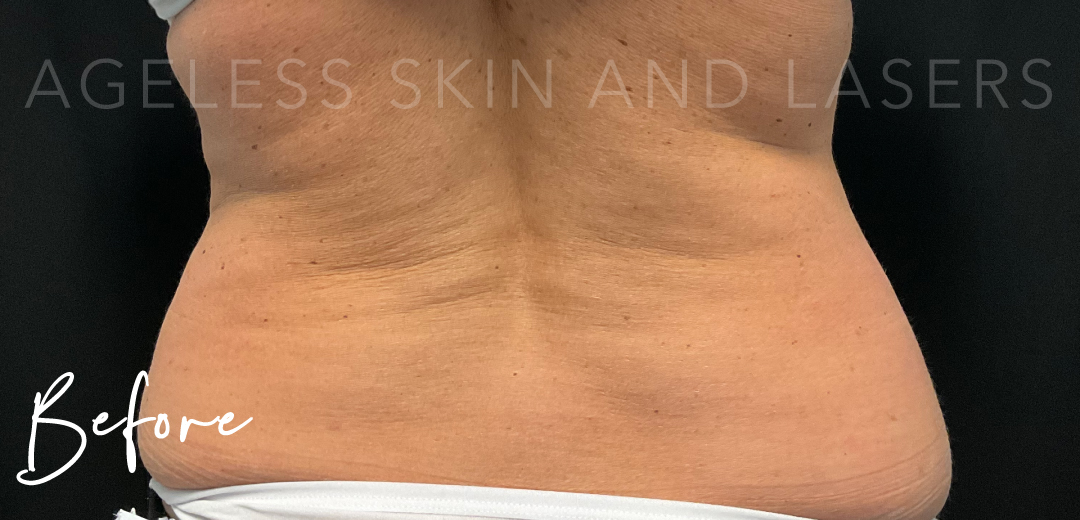 Before Image: CoolSculpting - back