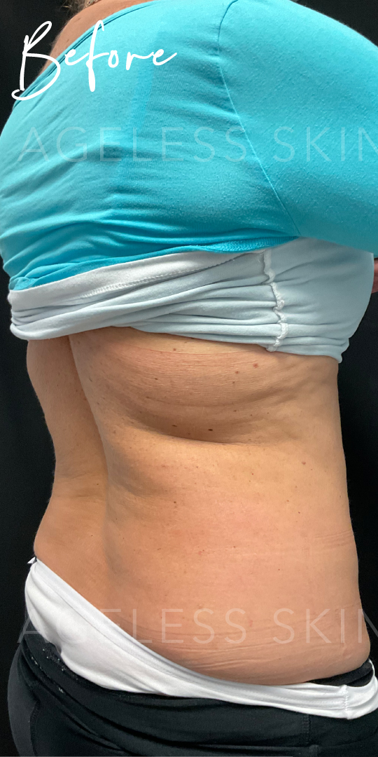 Before Image: CoolSculpting - right-back-oblique