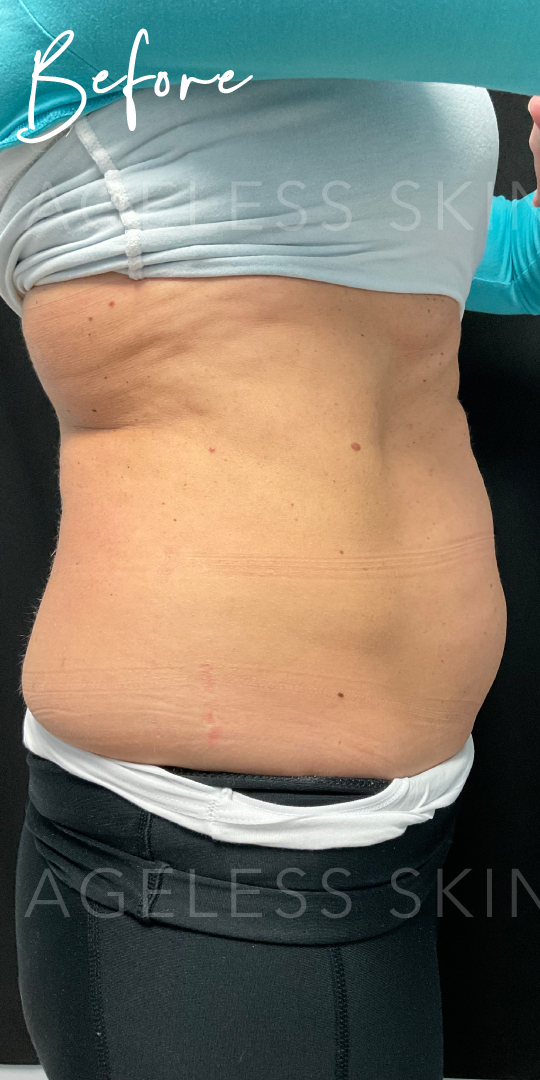 Before Image: CoolSculpting - right-side
