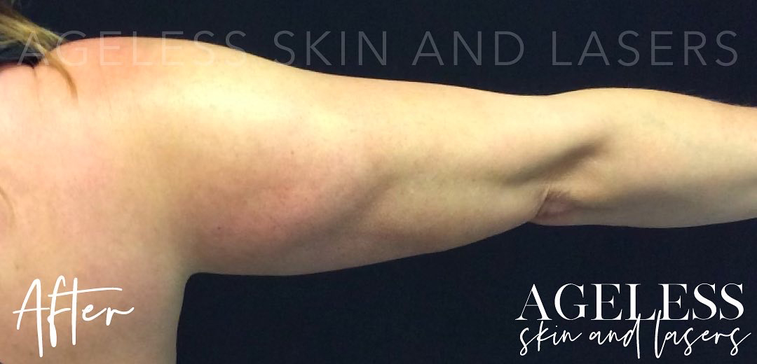 After Image: CoolSculpting - back
