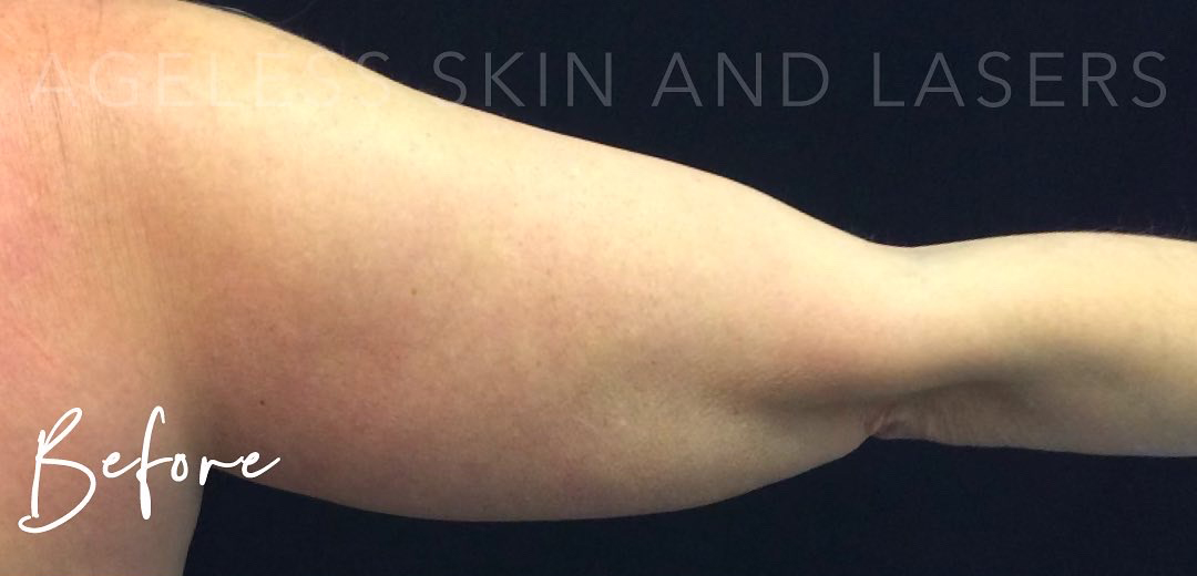 Before Image: CoolSculpting - back