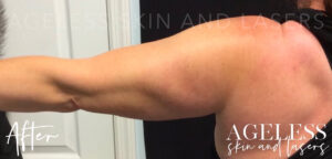 After Image: CoolSculpting