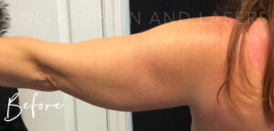 Before Image: CoolSculpting