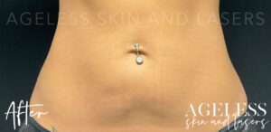 After Image: CoolSculpting