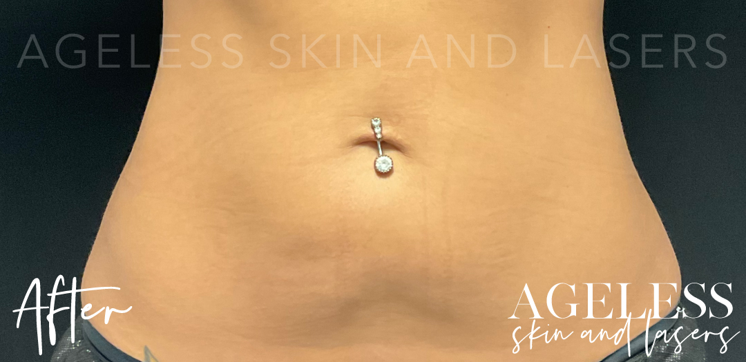 After Image: CoolSculpting - front