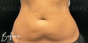 Before Image: CoolSculpting