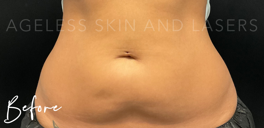 Before Image: CoolSculpting - front
