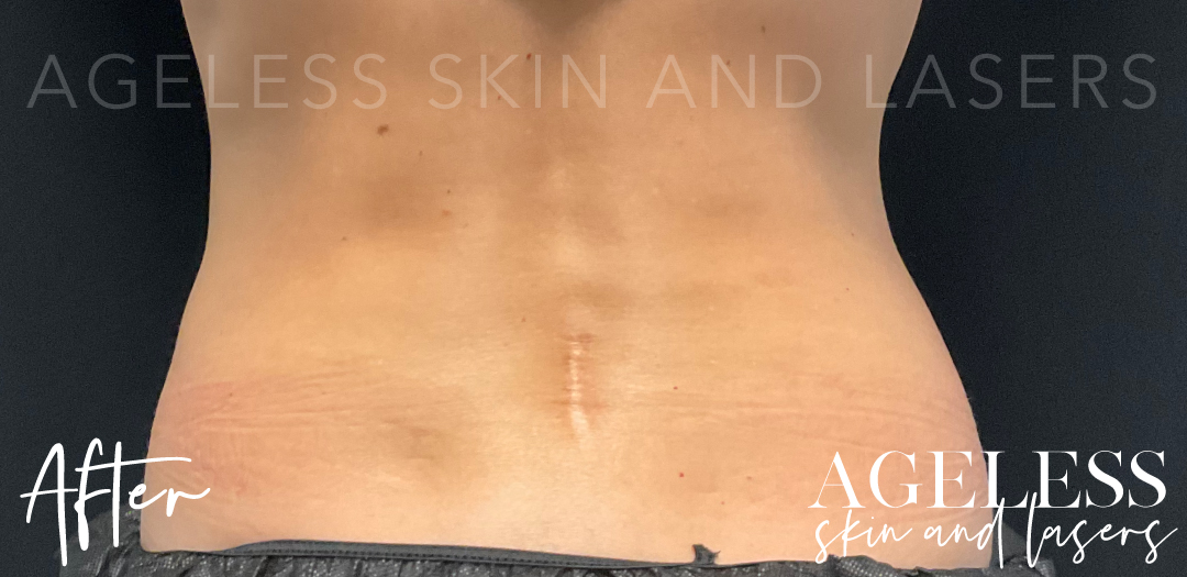 After Image: CoolSculpting - back