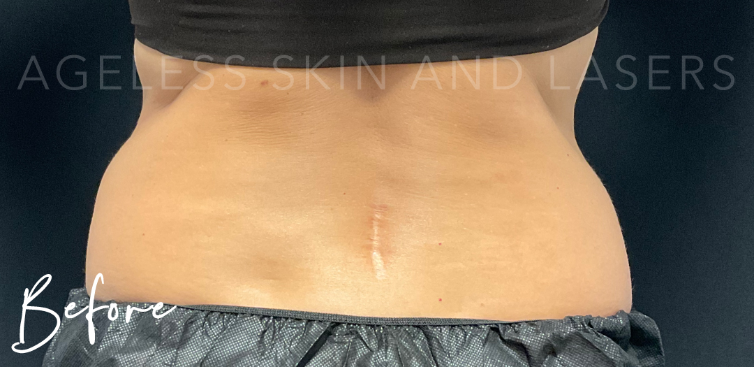 Before Image: CoolSculpting - back
