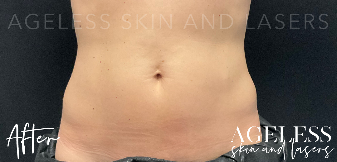 After Image: CoolSculpting - front