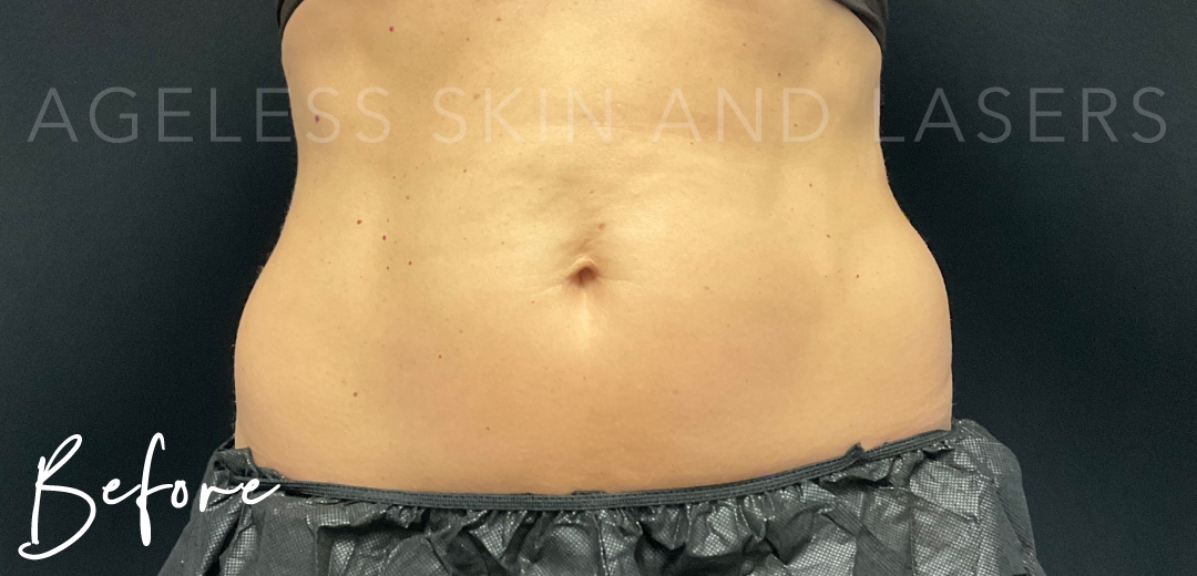 Before Image: CoolSculpting - front