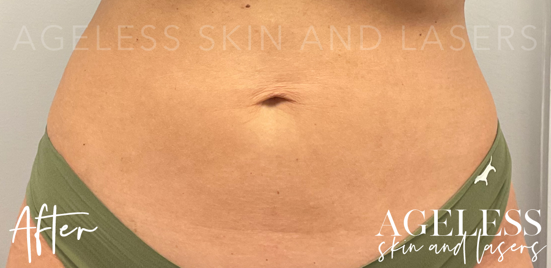 After Image: CoolSculpting - front