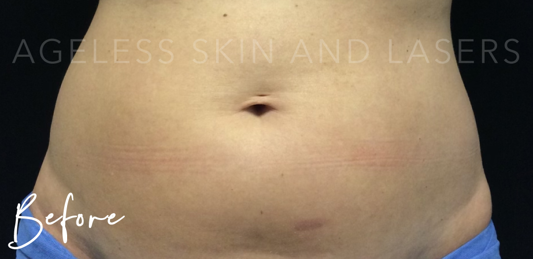 Before Image: CoolSculpting - front